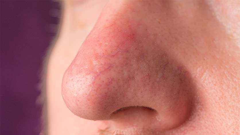 What Is Alcoholic Nose (Rhinophyma)? | Red Drinker's Nose