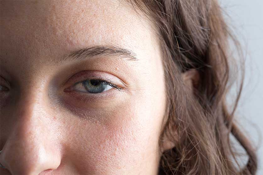 Woman With Eyes Affected By Opioid Use-Opioid Pupils | How Opioids Affect Your Eyes